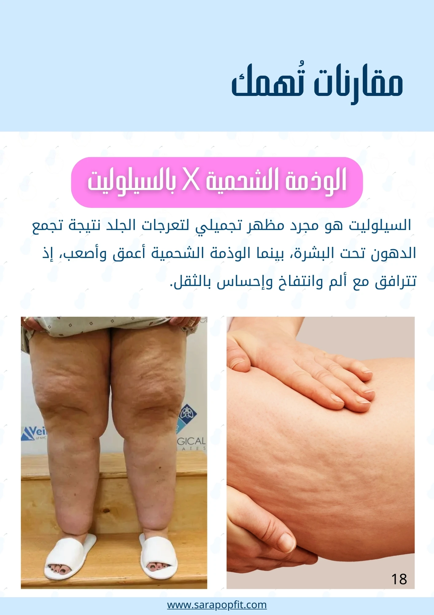 التخلص من الوذمة الشحمية - جسم الإجاصة